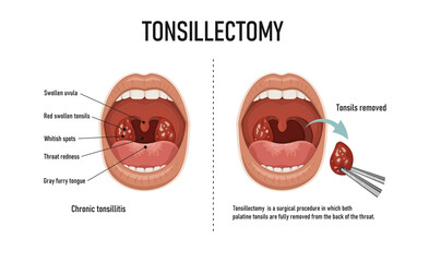 Tonsillectomy. Removal of palatine tonsils. Acute pharyngitis
