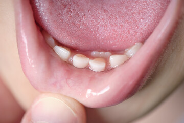 Open mouth of a child with milk teeth. Teeth in two rows. Shark tooth. The permanent incisors grew...