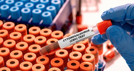 Cytomegalovirus (CMV) Test tube with blood sample in infection lab