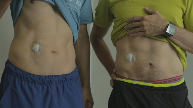 Two Diabetic Men Apply An Adhesive Patch To Their Skin To Test Their Blood Sugar Level