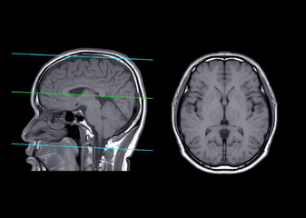 MRI  brain compare axial and sagittal plane .