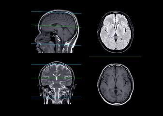 MRI  brain compare axial, coronal and sagittal plane