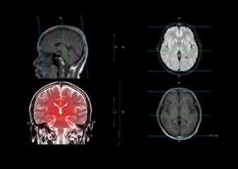 MRI  brain showing coronal plane of the brain  .