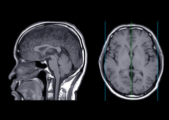 MRI  brain  axial T1W  plane  sagittal and axial view .
