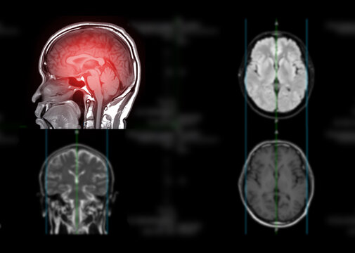 MRI  brain  axial T1W  plane  for detect stroke disease and Brain tumors and cysts.