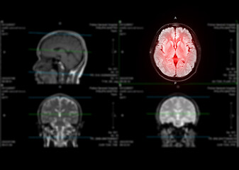 MRI  brain axial flair for detect stroke disease and Brain tumors and cysts.