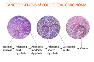 Cancerogenesis of colorectal carcinoma - obrazy, fototapety, plakaty