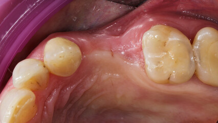 Obraz premium gum cavity without two teeth before implantation