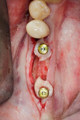 bone cavity with two dental implants installed. gingiva formers and soft tissue flaps