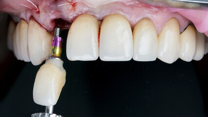 Fototapeta na wymiar the moment of installation of a dental crown with a prosthesis after implantation