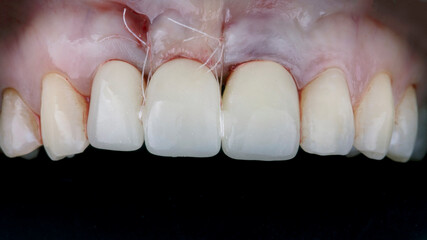 installed temporary dental crown of the central tooth on the abutment with suturing