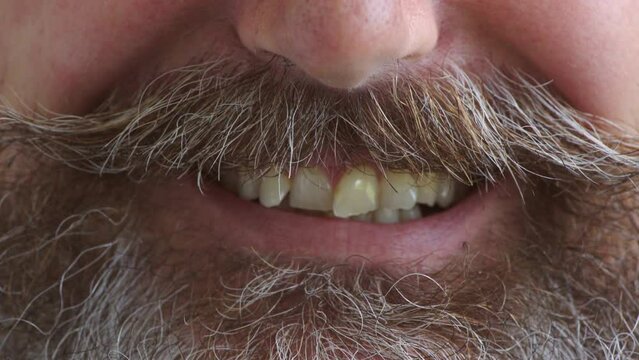 Closeup of bad teeth and crooked incisors in need of orthodontic repair and braces treatment. Overcrowded mouth and misaligned dental on a smiling mature man with an unshaven beard and moustache