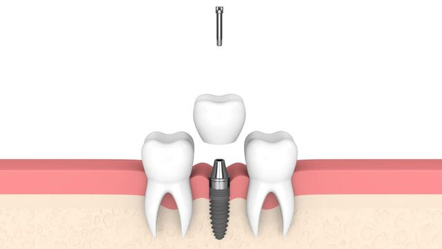 Dental implant placement into human gums over white background
