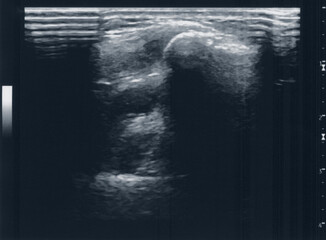 tendon muscle ultrasound sonography