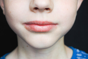 Cheilitis on the lips of a boy. Close up of dry, sore skin on face. Weathering and dry epidermis