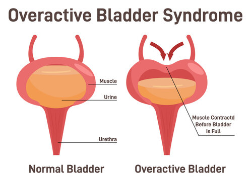 Overactive bladder syndrom. Normal bladder and bladder with urinary