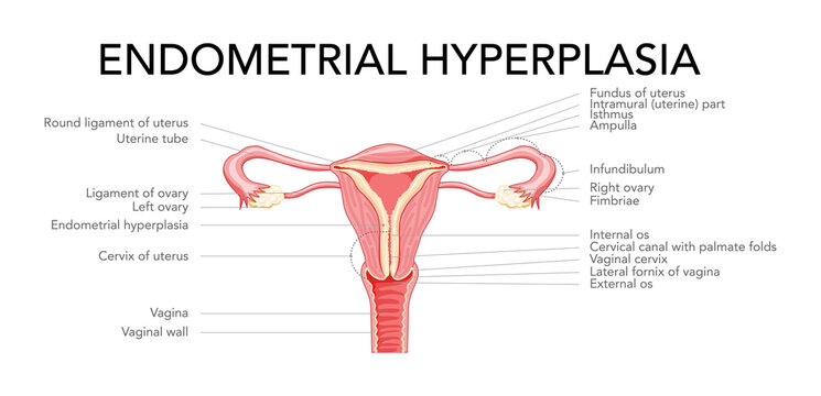 Endometrial hyperplasia Female reproductive system uterus with inscriptions medical diagram. Front view in a cut. Human anatomy internal organs diseases location scheme flat style icon