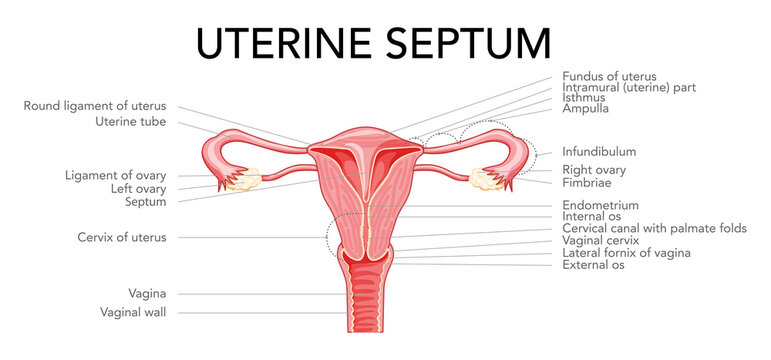 Uterine septum septate uterus Female reproductive system diagram with inscriptions text. Front view in a cut. Human anatomy internal organs flat style icon Vector medical illustration isolated
