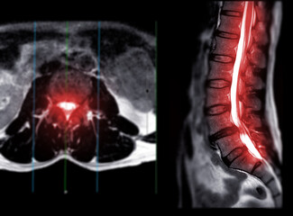 MRI L-S spine or lumbar spine Axial T2W view with sagittal plane .