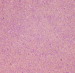 Neutrophilic leukocytosis, increase total count of White blood cell and increase number of...