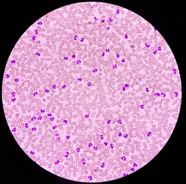 Neutrophilic leukocytosis, increase total count of White blood cell and increase number of neutrophils caused by bacterial infection, granulocytes in the blood, 40x view.