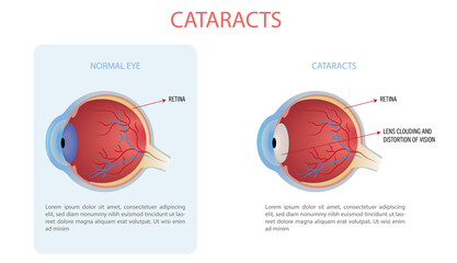 Vector illustration of cataract, cataract is a clouding of the lens of the eye that causes a loss of vision. - obrazy, fototapety, plakaty