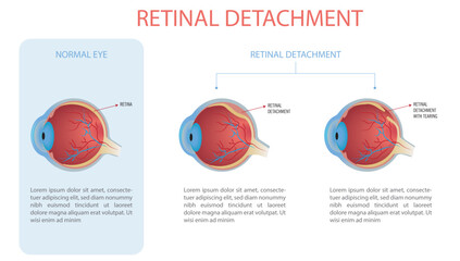 Infographic of a normal eye and an eye with retinal detachment, two types with and without tear.