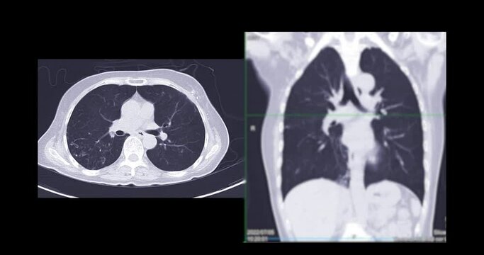 CT Scan of  Chest or Lung for diagnosis lung diseases.