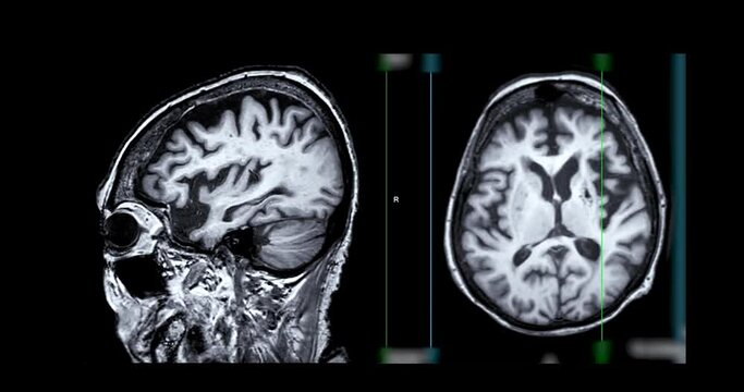 MRI of the brain compare sagittal and axial plane  for diagnosis stroke diseases.