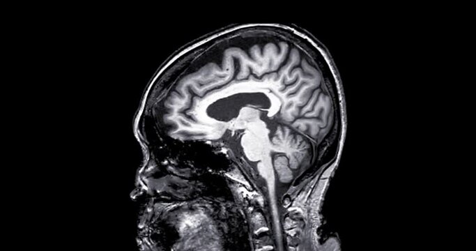 MRI of the brain  sagittal plane  for diagnosis stroke diseases.