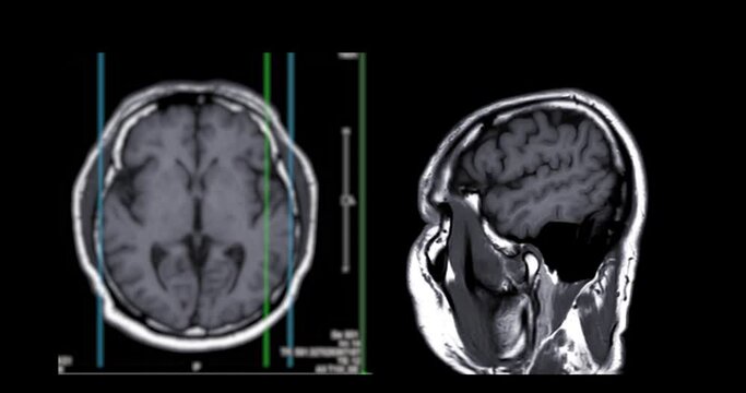 MRI of the brain  for diagnosis stroke diseases.