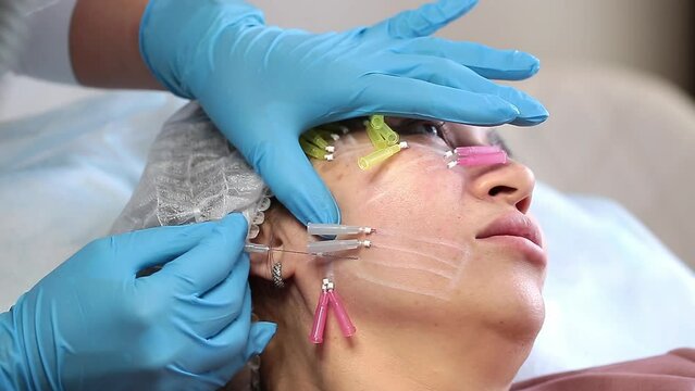 Thread Lifting" Images – Browse 401 Stock Photos, Vectors ...