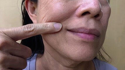 A woman has wrinkles on her face.