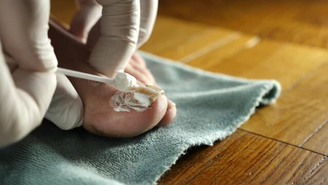 A medicinal cream is applied to the big toe affected by the fungus. Treatment of nail fungus.