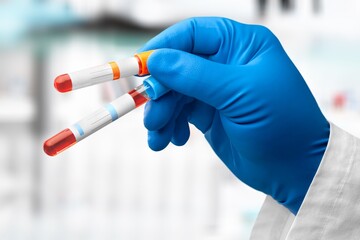 Blood samples of patient for test in laboratory. Blood tubes