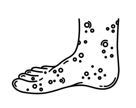 recommend clip art: Painful rash on the right human foot. Leg with ulcers, blisters, sores on the skin. Vector outline isolated on white. Symptom of a viral, allergic disease. Dermatitis, monkeypox, eczema