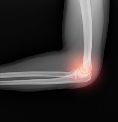 X-ray image of the elbow