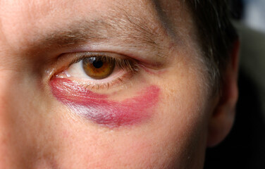 Bruise and swelling from a blow on the face of a man close-up