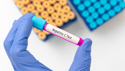Hepatitis C virus (HCV)  test result with blood sample in test tube on doctor hand in medical lab
