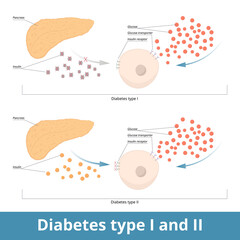 Diabetes type I and II. Schematic visualization of two diabetes types: type one (pancreas does not produce insulin) and type two (cells are unable to use it). - obrazy, fototapety, plakaty