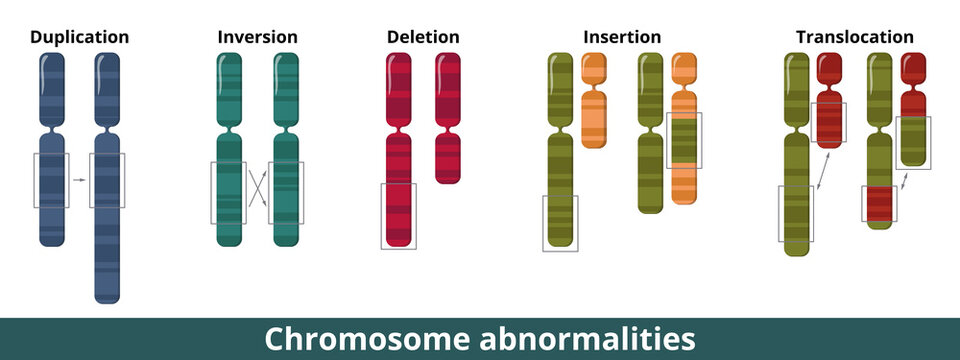 Chromosome abnormalities. Visualization of common chromosomal mutation or disorder. Numerical or structural abnormalities where is a missing, extra, or irregular portion of chromosomal DNA.