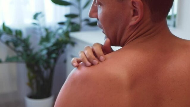 Man strokes and scratches sunburn skin on back and shoulders. Close-up view of back and shoulders with sunburn marks. Man with reddened itchy skin. Concept of sunbathe without sunscreen.