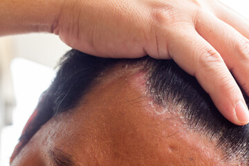 skin disease at the head, Dandruff is a common condition that causes the skin on the scalp to flake - obrazy, fototapety, plakaty