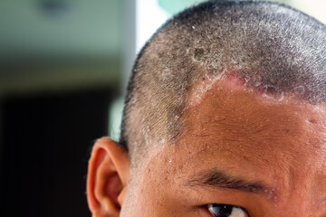 skin disease at the head, Dandruff is a common condition that causes the skin on the scalp to flake