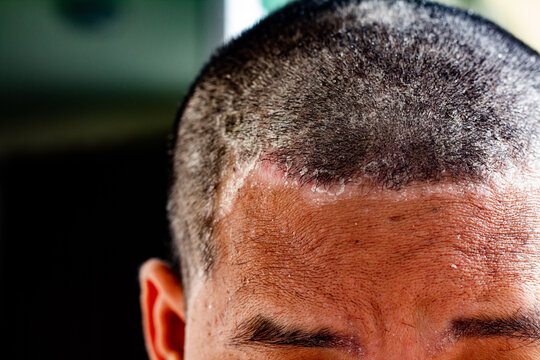 skin disease at the head, Dandruff is a common condition that causes the skin on the scalp to flake