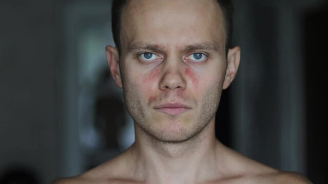 allergic reaction on the face of a young man, symptoms of chronic urticaria autoimmune lupus.