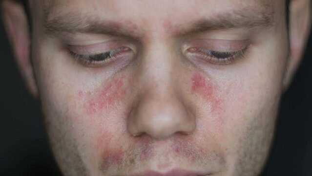 allergic reaction on the face of a young man, symptoms of chronic urticaria autoimmune lupus.