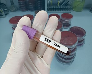 Blood sample for erythrocyte sedimentation rate (ESR) test. Medical test tube in laboratory...