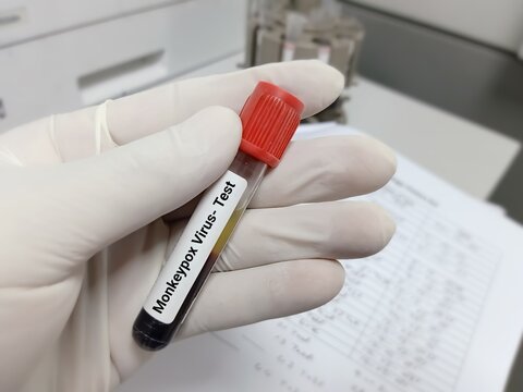Scientist hold blood sample for Monkeypox virus test. A member of the Orthopoxvirus genus in the family Poxviridae.