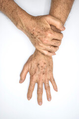 Age spots on hands of Asian man. They are brown, gray, or black spots and also called liver spots,...